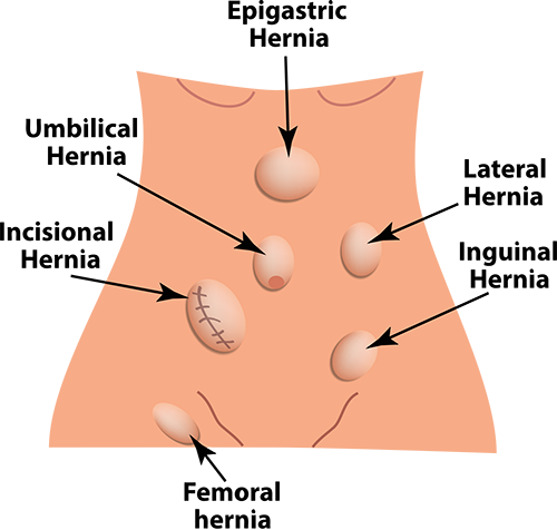 How are inguinal and femoral hernias treated in women?